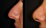 Operacja plastyczna nosa 1
