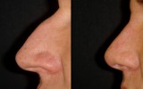 Operacja plastyczna nosa 2