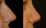 Operacja plastyczna nosa 5