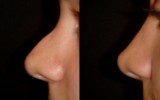 Operacja plastyczna nosa 6
