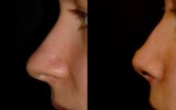 Operacja plastyczna nosa Łódź