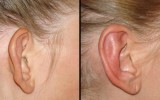 Operacja plastyczna uszu