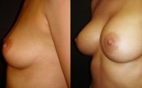 Powiększanie piersi 2
