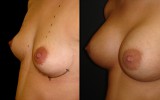 Powiększanie piersi 7